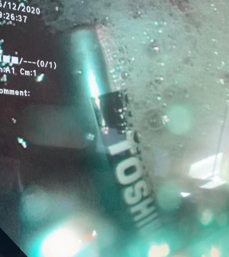 הסוללה בבטנו של בן ה-7 | צילום: ביה"ח "ברזילי"